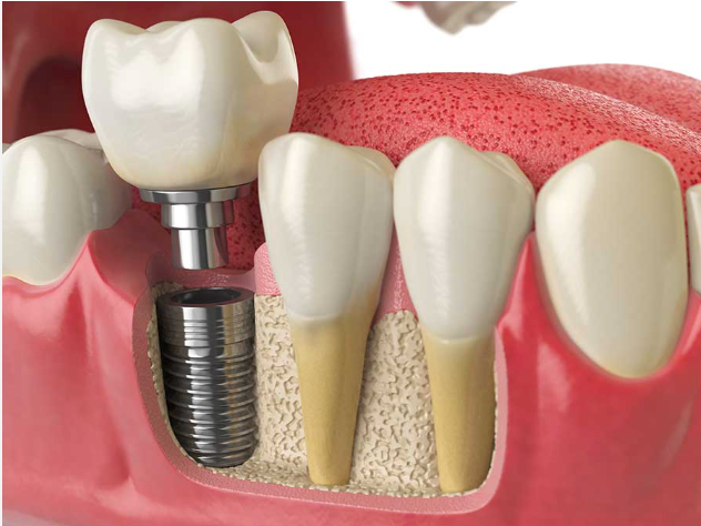 Implant dentaires quelle brosse à dents utiliser ?