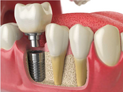 Implant dentaires quelle brosse à dents utiliser ?