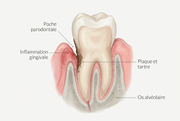 Poches parodontales : comment nettoyer là où votre brosse à dents ne va jamais